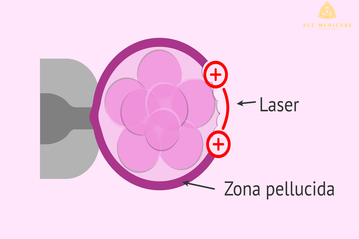 The Science Behind Laser-Assisted Hatching: Understanding the Process